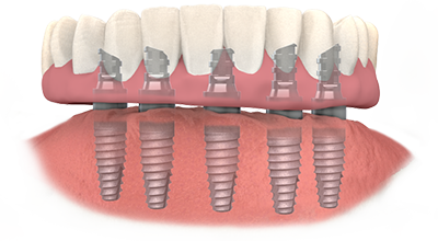 TeethXpress with Prosthesis