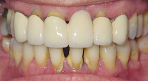 before dental implants