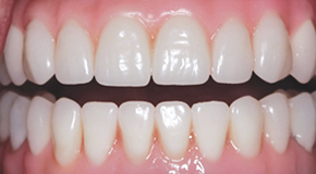 after dental implants